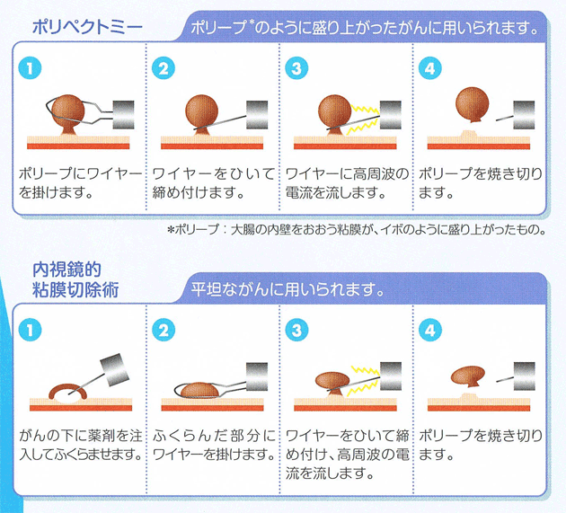 後 ポリープ 食事 切除 大腸ポリープ切除後の食事では乳製品は控えるのか控えないのか