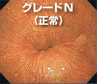 グレードN(正常)